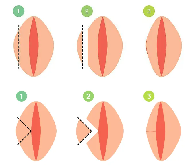 Labiaplasty surgery