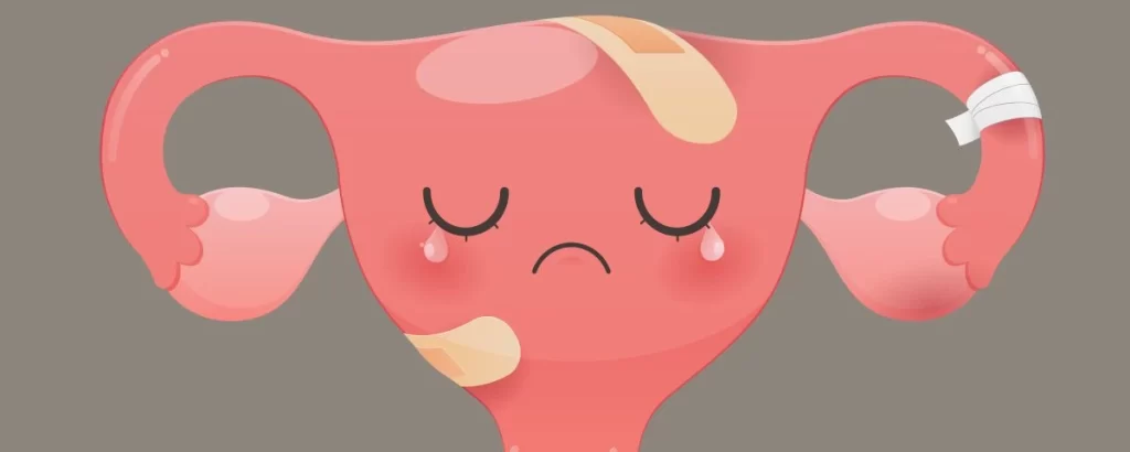 پیچ خوردگی تخمدان