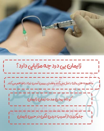 زایمان بی درد با بی حسی اپیدورال