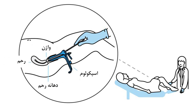 PapSmear